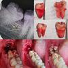 Wisdom Tooth Extraction Cost near me in Hyderabad