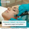 Exosomes Therapy for Rosacea: Experience Longer Lasting Relief