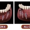 What Are All on 4 Dental Implants and Why Choose Them | Smile Dental and Implant Centre